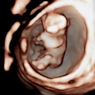 임신 11주차 증상 12주차 1차 기형아 검사 목투명대 정상