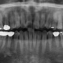 염증으로 인한 광범위한 골 흡수 동탄 치과 뼈이식을 동반한 임플란트 식립으로 기능 회복
