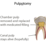 [치의학 #14] Pulpotomy(치수 절단술)