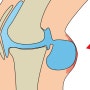 무릎 뒤쪽 오금에 발생하는 통증 원인 - 베이커 낭종 물혹 치료