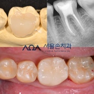 가락동 가락시장역치과, 신경치료 후 크라운 하지 않는 경우에 대해_"이맥스온레이"