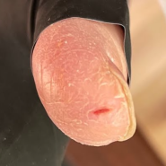 손끝 갈라짐 손가락 갈라짐 갈라지는 피부 껍질 벗겨지는 트는 이유 증상 치료 대한 정보