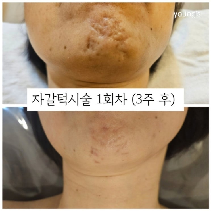 룩서스플라즈마로 부작용없는 자갈턱보톡스 효과보기 (후기, 기간, 비용) : 네이버 블로그