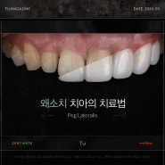 티유치과 5월 매거진, 왜소치 치아의 치료법 [TU치과]