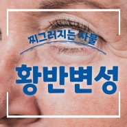 나의 눈 건강을 위한 첫걸음! 황반변성 미리 발견하고 실명 위험에서 벗어나자!