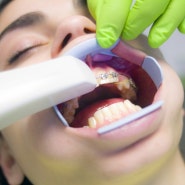 치아교정 중에 치아관리가 너무 어렵다면?