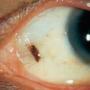 결막모반 눈 눈동자 눈알 동공 갈색점 검은점 눈에 반점 보이는 원인 및 증상, 흑색종 및 암 가능성까지