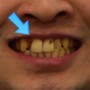 치아교정과 임플란트 보철, 신경치료 및 충치치료 과정