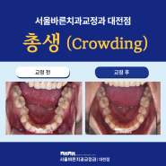 대전투명교정치과 치아가 삐뚤빼뚤한 총생(Crowding), 인비절라인으로 교정