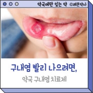 구내염 빨리 낫는법_약국 입병(구내염)치료제