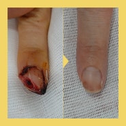 손가락 절단, 베인 상처 후 발생한 피부 괴사 치료