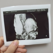 임신일기 ✦ 20주차 초음파, 임산부 감정기복 산전우울증..?