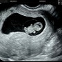 난임검사 할뻔했던 임신 초 중기 기록(4주~16주) 임신초기 코로나확진, 기형아검사