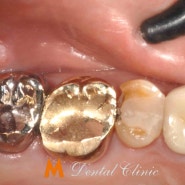 대구 충치치료추천 실력있는 치과에서 치료해야하는 이유
