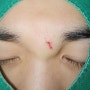 신중동 얼굴 봉합 미간 부위 찢어진 상처