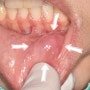 입술씹었을때 깨물었을때 안쪽에 발생할 수 있는 점액낭종 입술물혹은 치과에서 치료받으세요 "입안물집이 커졌다 작아졌다하는데 안없어져요"