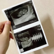 임신10주 임신 초기 3개월 증상 입덧 & 절박유산 이후 젤리곰
