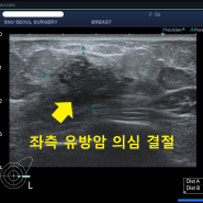 총조직검사로 가능한 미세석회화조직검사사례 ;; 유방조직검사병원 SNU서울외과