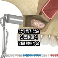 미아역 치과 상악동거상술 및 잇몸뼈이식 비용을 줄이면서 임플란트수술 하는 방법