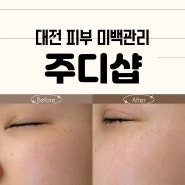 대전 피부 미백관리 기미 잡티 제거 잘하는곳 주디샵 추천