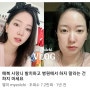 유튜버 멸치 사랑니 발치 후 통증 붓기 주의사항 중요성? 런던의오후치과!