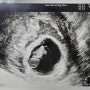 임신 7주 - 8주 :: 계속되는 피고임, 입덧 지옥 시작, 첫 젤리곰을 보다