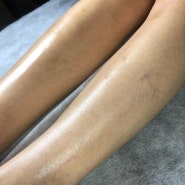 면도없이 깨끗한 다리 종아리왁싱 후기