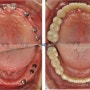 [전악임플란트]전체 치아가 빠져서 치료가 필요한데 몇 개의 임플란트 식립이 필요할까요?