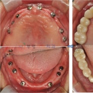 [전악임플란트]전체 치아가 빠져서 치료가 필요한데 몇 개의 임플란트 식립이 필요할까요?