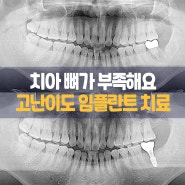 수원 치과 추천 - 뿌리염증으로 뼈가 부족한 고난이도 임플란트 수술 케이스 증례입니다.