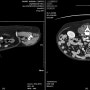 강아지 비만세포종 (MCT) 의 CT 전이 평가 증례