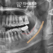 성남 치과 에서 잇몸뼈 녹음 심한 어금니, 하치조 신경과 밀접해도 네비게이션 임플란트 시술로 부작용 없이 빠르게