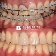 인천 구월동 치과 양악 수술 협진 & 임플란트 식립으로 올바른 교합을 찾아드렸던 증례🍀