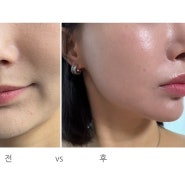 강남 피부관리 에스테틱노엘 찐 후기 (전, 후 비교)