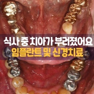 수원 시청역 치과 식사하시다가 치아가 부러진 환자분의 치료 과정입니다.