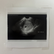 임신기록 (3) - 임신 5주차 아기집 확인, 6주차 난황, 아기 확인