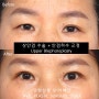 중년 상안검 수술 : 짝눈 / 안검하수 / 수술회복과정 【Dr. 아베크 눈성형】