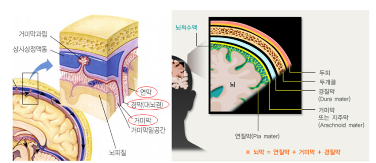cerebral hemorrhage(EDH, SDH, SAH, ICH) : 네이버 블로그
