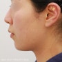 강남역 시크릿 피부과, 울쎄라 리프팅 400샷 + 턱밑샘보톡스 효과