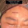 이마 찢어진 상처 : 성형외과 상처봉합 및 흉터 【Dr. 아베크 봉합수술】