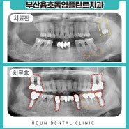 부산용호동임플란트치과 편안한 식사를 도와드리는!