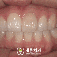 포항 치과 잘하는곳 - 타치과 신경치료 후 치아 변색 치료 증례