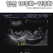 임신 10주차 11주차 입체초음파시기 1차 기형아 검사 투명대 두께 입덧ing