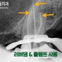 성남 치과 의사가 가족에게 임플란트 대신 브릿지 보철을 해준 이유(ft. 신경치료)