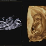 임신 12주 2일 초음파, 1차 기형아검사, 목투명대, 성별 초음파 각도법