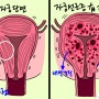 자궁선근증 통증 일반 생리통 아닌 이유