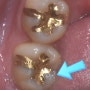 어금니 임플란트 수술, 금간 치아(크랙) 증상 및 교합적 고려