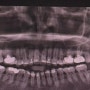 원주 치과의정석(신경치료 1년 후 재방문후기)(내돈내산)(내고통내아픔)(할머니가되도치과는무섭겠지)