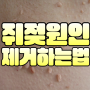 쥐젖 원인과 제거하는 방법 예방법 (얼굴, 목, 겨드랑이)