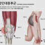 달리기 무릎통증 , 장경인대 증후군 문제는 근막장근